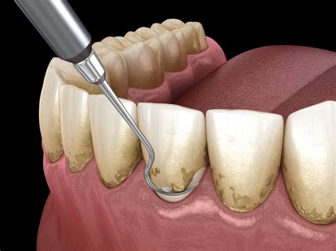 How To Remove Tartar And Plaque From Your Teeth Without A Dentist?