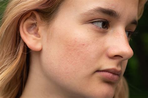 What are the stages of Rosacea? - SummitMD Dermatology