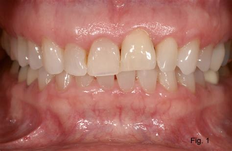 Ankylosis Part II: Treating Adults With an Ankylosed Tooth - Spear ...