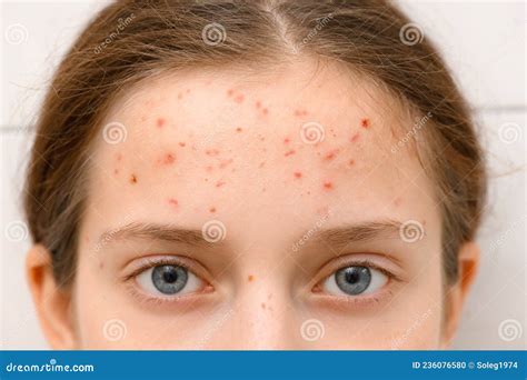 Face of a Teenage Girl with Pimples, Acne on the Skin, Portrait of ...