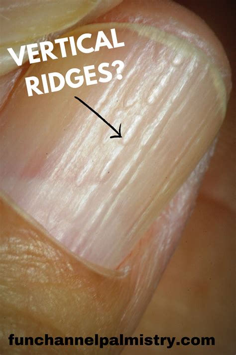 Vertical Lines On Nails - Fingernail Ridges Can Indicate a Thyroid ...