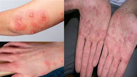 Tag: Penyakit Scabies Adalah - Apa Itu Penyakit Scabies Pada Manusia ...