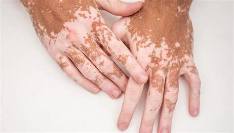 Vitiligo: What Is It, Symptoms, Treatment, Causes, And More, 49% OFF