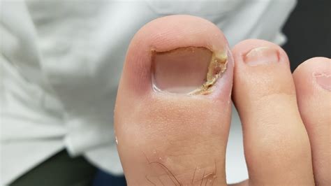 How to treat an ingrown toenail explained.