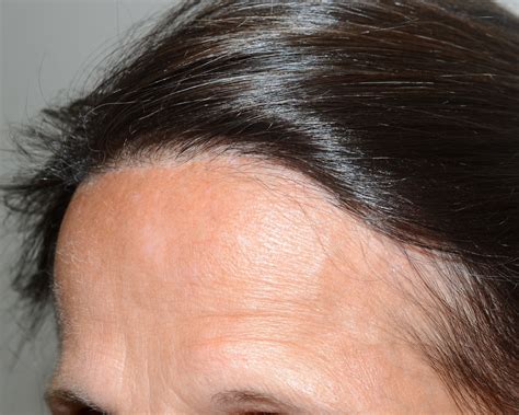 Frontal Fibrosing Alopecia - Dr Epstein