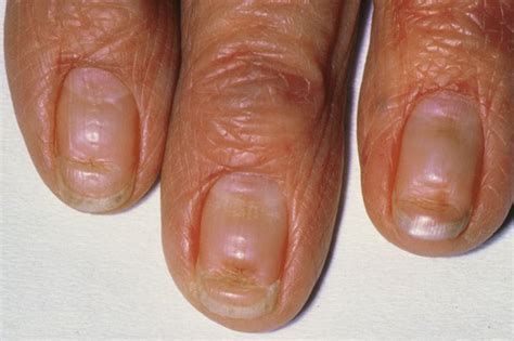 Vertical Lines On Fingernails Deficiency