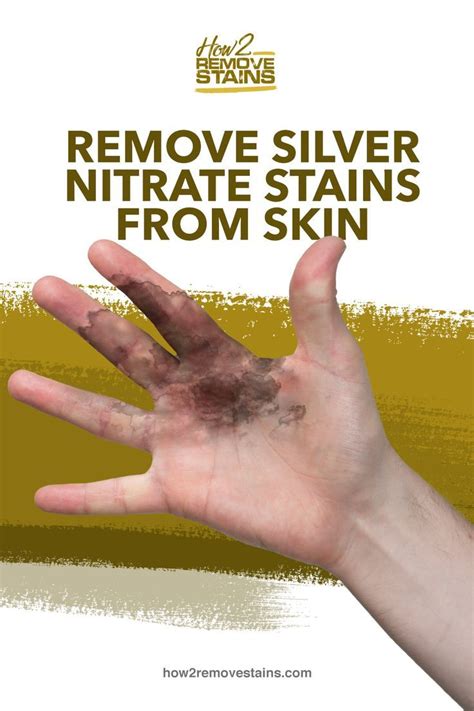 How to Remove Silver Nitrate Stains from Skin