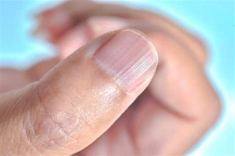 Vertical Lines on Fingernails | How To Achieve Healthy Nails