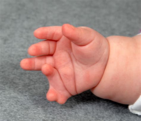 Small finger polydactyly, extra fingers | Congenital Hand and Arm ...