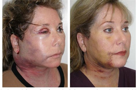 Figure 4 from Complications in facelift surgery and their prevention ...