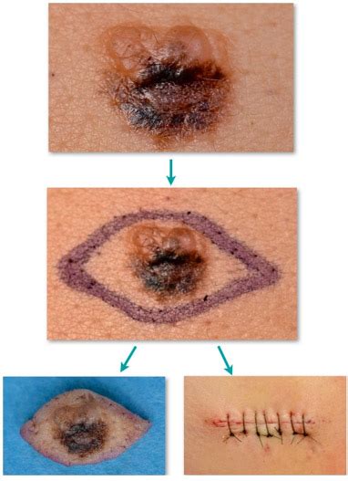 Melanoma Diagnosis - Melanoma Institute Australia