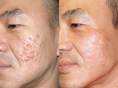 Acne Scars Boulder CO, Ideal Dermatology / Skin. PC