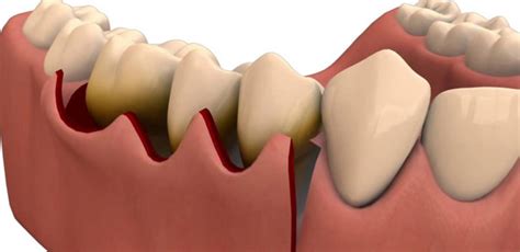 Flap Surgery – Dr. Harshal's Dental Implant & Pyorrhea Centre