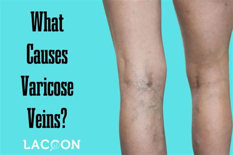 Risk Factors Involved: What Causes Varicose Veins? | Lacoon