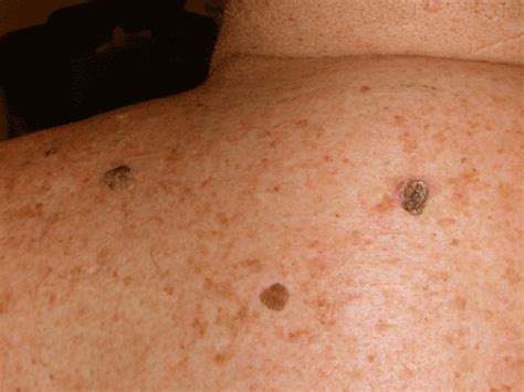 Seborrheic Keratosis Symptoms And Causes Seborrheic Keratosis | The ...