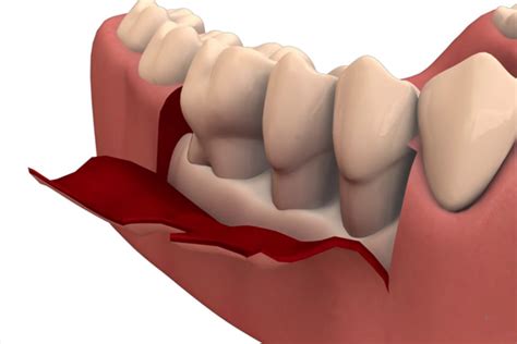 Flap Surgery – Silam Dental Clinic