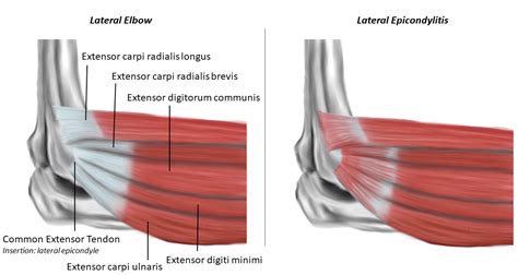 Common Extensor Tendon Abnormality Lateral Epicondylitis | Hot Sex Picture