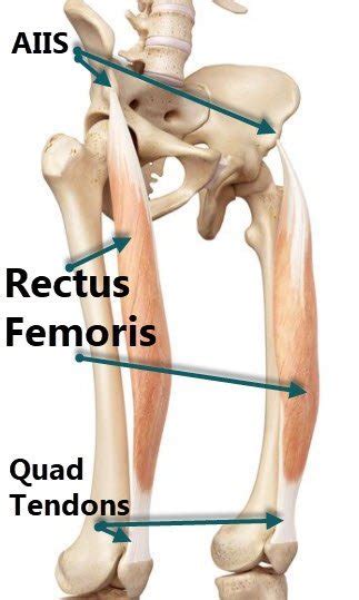 Rectus Femoris Strain