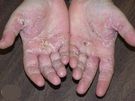 Eczema - Hand, Face, Baby, Causes, Symptoms & Treatment