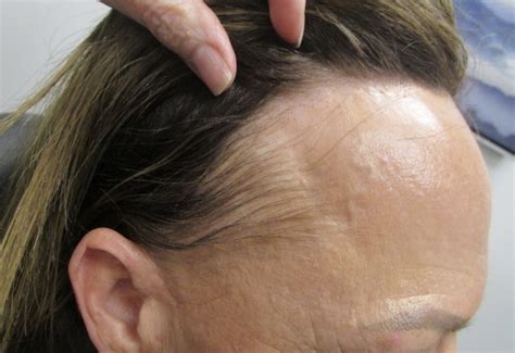 A New Epidemic: Frontal Fibrosing Alopecia | Skin Bones CME