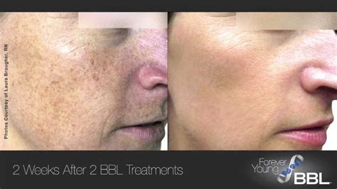 Laser Treatment of Brown Spots - Dermatology Care of Charlotte