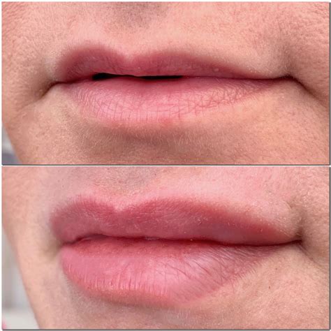 Hyaluron pen lip filler - manetbell