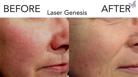 Laser Genesis Skin Rejuvenation – Cascades Med Spa