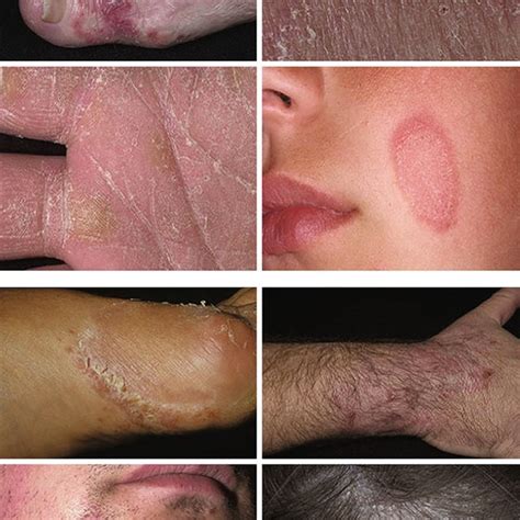 2 Pictures showing the types and distribution of infection on different ...