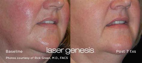 Laser Genesis Treatment - Benefits - Cost - Orange County