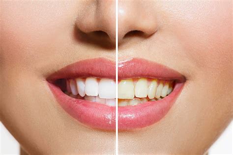 Yellow Teeth Are Actually Stronger Than Bright White Teeth | The Healthy