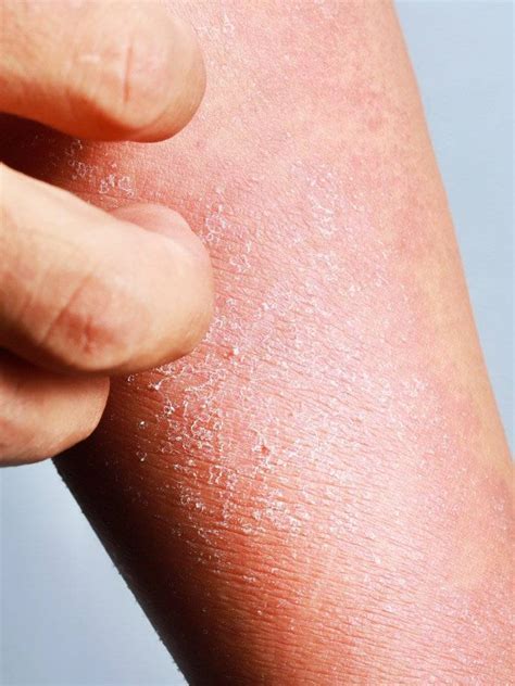 Eczema vs Psoriasis: What's the difference? - Cambridge Therapeutics