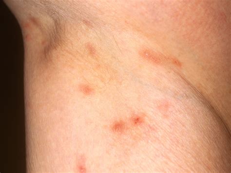 Rashes That Look Like Scabies: Causes, Symptoms, And, 59% OFF