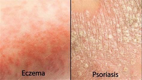 Eczema vs Psoriasis – Which One Do I Have? – Ultra Bee™