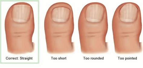 Ingrown Toenail Prevention | Melbourne Podiatry Clinic