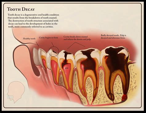 Medical Sundries: Tooth decay