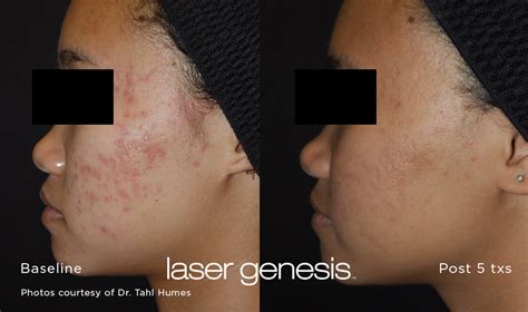 xeo_Laser Genesis-Acne Scars_1 | PHYSICIANS BODY SCULPTING