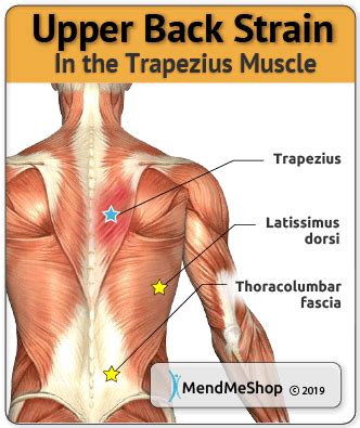 Trapezius Strain