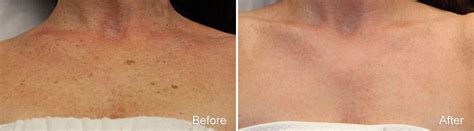 Laser Treatments Photos | Philadelphia, PA | Patient 1180