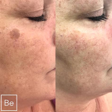 Sun Spot and Age Spot Removal in Rochester, NY | Bare Element