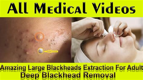 Blackhead Removal Videos May 2024 - Rhody Kristine