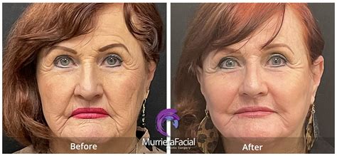 Laser Facelift – Murrieta Facial Plastic Surgery