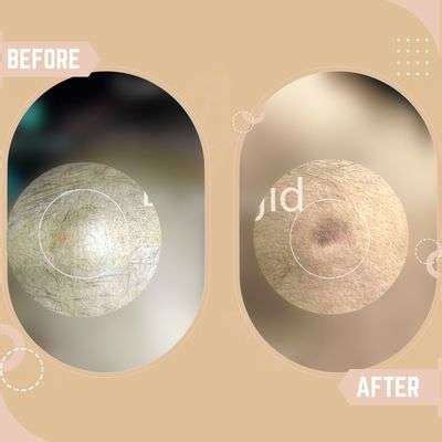 Cyst Removal Aftercare – SkinQure