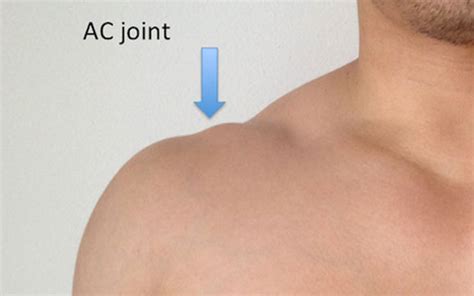 Acromioclavicular Joint Arthritis