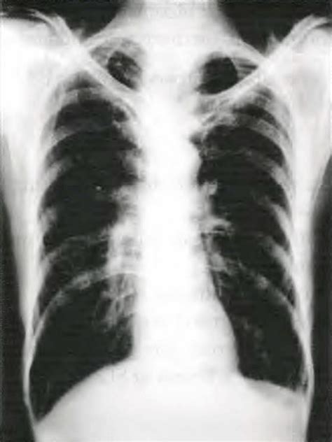 X-ray Emphysema - Rimikri Med