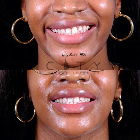 Asymmetrical Lips Surgery Cost | Lipstutorial.org