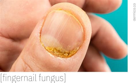 Hand Nail Fungus