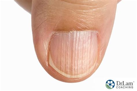 Vertical Lines On Fingernails May Indicate Certain Health Issues