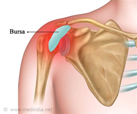 Subdeltoid Bursitis