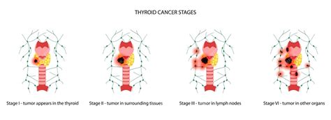 Premium Vector | Thyroid cancer stages