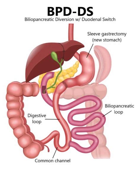 Duodenal Switch - ASTRAMEDICA